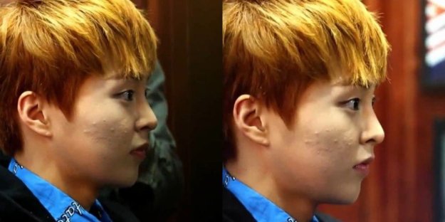 misc_1476493391_acne5