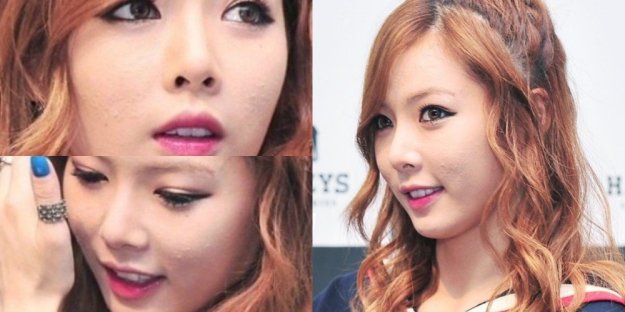 misc_1476493434_acne6