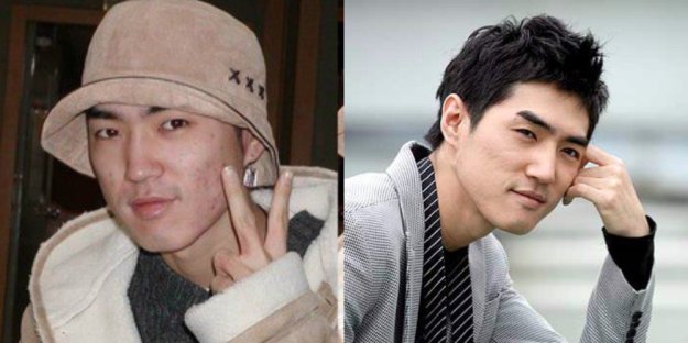 misc_1476493987_acne10